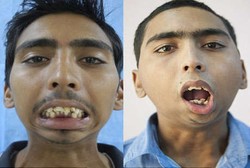 8 Tahun Rahang Menyatu, Akhirnya Remaja Ini Bisa Membuka Mulutnya