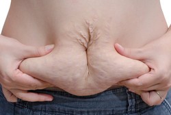 Bobot Tubuh Turun Drastis Usai Melahirkan Sisakan Kantong Kulit di Perut