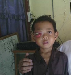 Dianiaya Kakak Kelasnya, Mata Sebelah Kanan Bocah Kelas 1 SD Buta