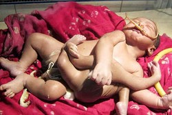 Lahir dengan Empat Kaki dan Tangan, Bayi Ini Bikin Heboh India