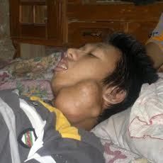 Mukminin Hanya Bisa Tergolek Lemah dengan Tumor di Lehernya