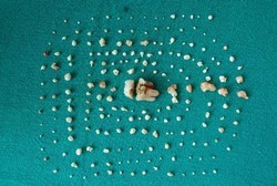 Mulut Bocah 7 Tahun Bengkak, Rupanya Ada 202 Gigi Tertanam di Gusi