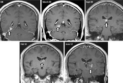 Hii! Ada Cacing Hidup di Otak Pria Inggris Selama Empat Tahun