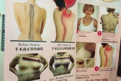 Payudara Tidak Seimbang, Tulang Punggung Rawan Cedera