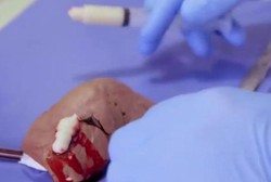 Gantikan Plester, Gel Ini Dapat Tutup Luka dalam Hitungan Detik