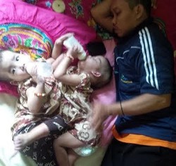 Ini Kondisi Kembar Siam Citra-Nezya Saat Dirawat di Rumahnya