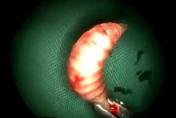 Hii! 50 Ekor Belatung Pemakan Daging Bersemayam di Hidung Pria India