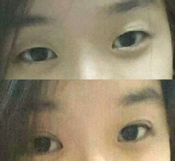 Foto: Perubahan Penampilan Wanita Indonesia Pasca Jalani Operasi Plastik di Korea