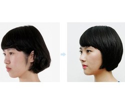 Dos & Donts Sebelum Renovasi Penampilan dengan Operasi Plastik di Korea