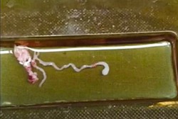 Jajan Sembarangan, Bocah 11 Tahun Terinfeksi Cacing Parasit di Otaknya