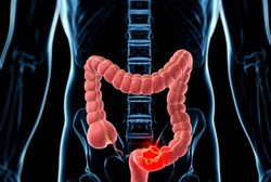 Jika Dideteksi Sejak Awal, Peluang Kanker Usus Besar Bisa Sembuh 95 Persen