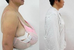 Bukan Tumor, Payudara Wanita Ini Membesar Karena Kondisi Langka