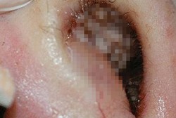 Dihinggapi Lalat Saat Tidur, Mata Pasien Ditumbuhi 120 Belatung