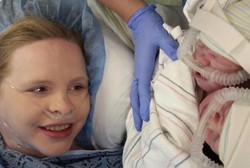 Setengah Tubuhnya Menyatu, Bayi Kembar Siam Lahir Selamat di Amerika