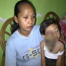 Beginilah Penderitaan Fadil, Bocah 3 Tahun Penderita Tumor Mata Ganas