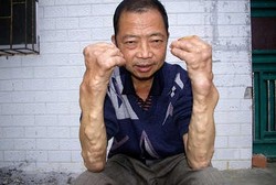 Tercemar Logam, Muncul Benjolan Aneh di Kaki dan Tangan Warga Desa Ini