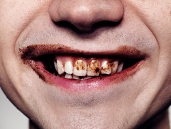 Selain Permen, 8 Makanan Ini Juga Merusak Gigi (1)