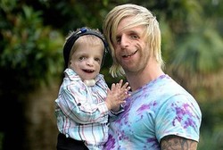 Berwajah Tak Sempurna, Jono Terus Menginspirasi Anak yang Senasib Dengannya