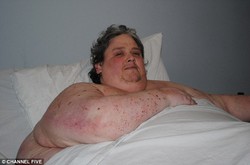 Pria Super Gemuk Asal Inggris Meninggal di Usia 44 Tahun karena Pneumonia