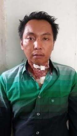 Paminal Polri Periksa Kuswanto yang Lehernya Diduga Dibakar Aparat