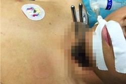 Ya Ampun! Sumpit Mi Menancap di Tenggorokan Bocah 12 Tahun Ini