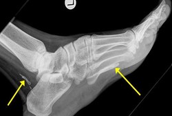 Bertahun-tahun, Ada Cacing Afrika Hidup di Kaki Pria Australia