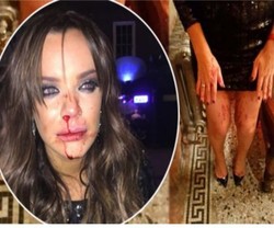 Tragis, Model Cantik Keluar dari Klub Malam dengan Wajah Berlumuran Darah