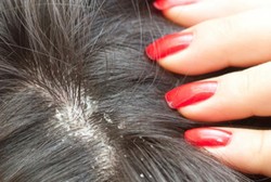 Begini Akibatnya Jika Jamur Penyebab Ketombe Tidak Diobati