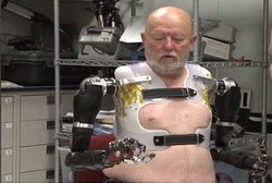 Pertama Kali, Pasien Gunakan Dua Lengan yang Dikendalikan Pikiran