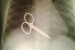 Gunting Kuku Tersangkut di Jantung, Bocah Ini Berhasil Selamat