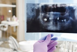 Bocah di India Idap Tumor Gigi, Dokter Angkat 80 Gigi Ekstra di Mulutnya