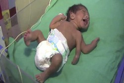 Satu dalam Sejuta, Bayi Ini Lahir dengan Tiga Tangan