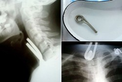 Leher Terasa Sakit, Ternyata Ada Logam Nyangkut di Kerongkongan Pria Ini