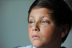 Dokter Salah Diagnosis, Calvin Berisiko Buta Akibat Steven Johnson Syndrome