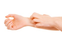 Punya Kulit Eksim, Hati-hati Risiko Osteoporosis Meningkat