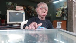 Remaja Berkulit Ular Asal Tangerang yang Menarik Perhatian Dunia