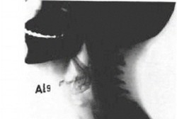 Belut Hidup 5 Jam Tersangkut di Tenggorokan, Remaja Ini Hampir Meninggal