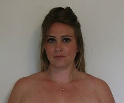 Operasi Plastik Gagal, Puting Payudara Wanita Ini Harus Diangkat