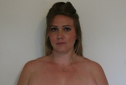 Gara-gara Dokter Ceroboh, Wanita Ini Kehilangan Puting Susu