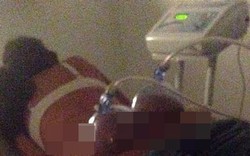 Vakum Bokong, Perawatan untuk Bokong Seksi Seperti Kim Kardashian