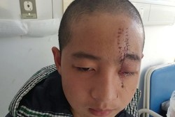 Dahi Tertusuk Cutter Listrik, Pria di Tiongkok Masih Bisa Selamat