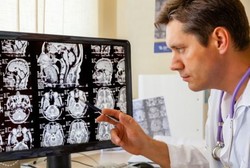 Spinocerebellar Ataxia, Penyakit Saraf Genetik yang Bikin Lumpuh Sekeluarga