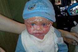 Dikira Menular, Bocah dengan Sakit Kulit Langka Ini Dijauhi