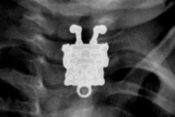 Ada SpongeBob Terjebak di Kerongkongan Balita Ini