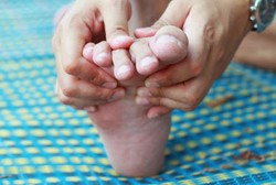 Bisa Disembuhkan, Tak Ada Lagi Alasan untuk Diskrimasi Pengidap Kusta