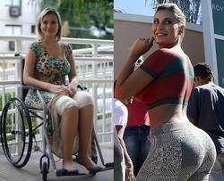 Seram, Paha Ratu Bokong Terseksi Ini Bolong-bolong Pasca Operasi Plastik