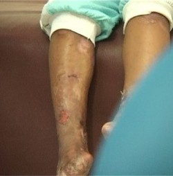 Bocah Dua Tahun Asal Deli Serdang Derita Penyakit Kulit Langka