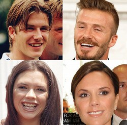 Before & After Penampilan 10 Selebriti Dunia yang Pakai Veneer Gigi