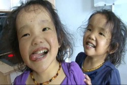 Perjuangan Wagner Cari Donor untuk Putri Kembarnya yang Sakit Hati Langka