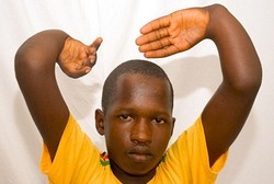 Kisah Mamadou, Remaja yang Dijuluki Bertangan Setan karena Kondisi Langka